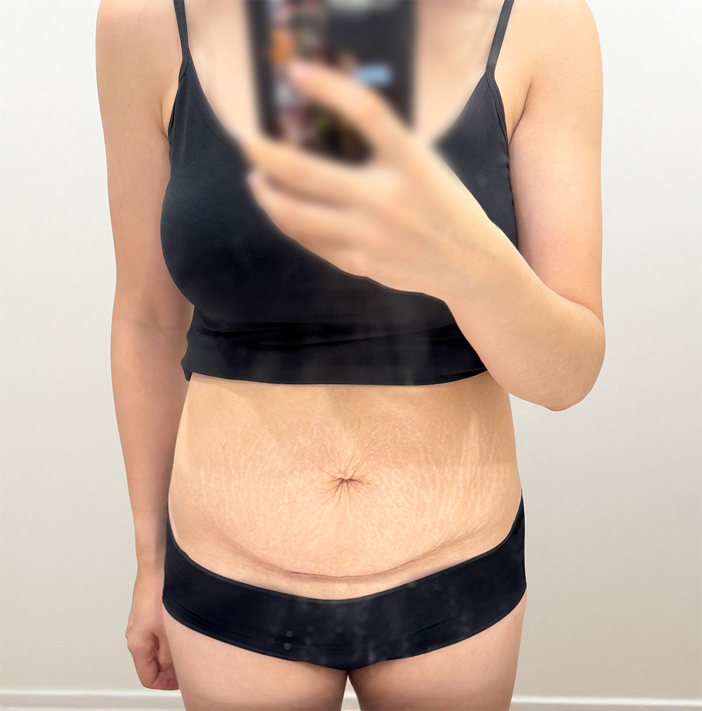 tummy-tuck-geuramijireong-before