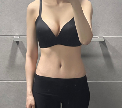 tummy-tuck-leonnim-after