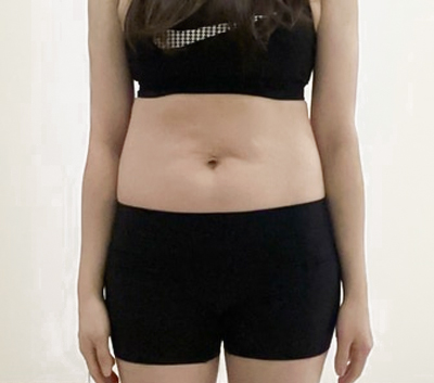 tummy-tuck-leonnim-before