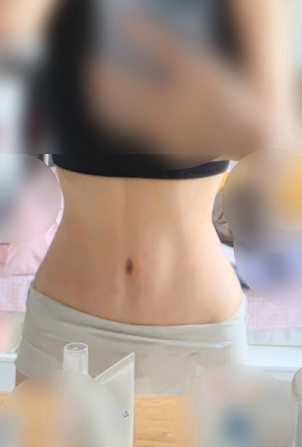 tummy-tuck-powerful-after