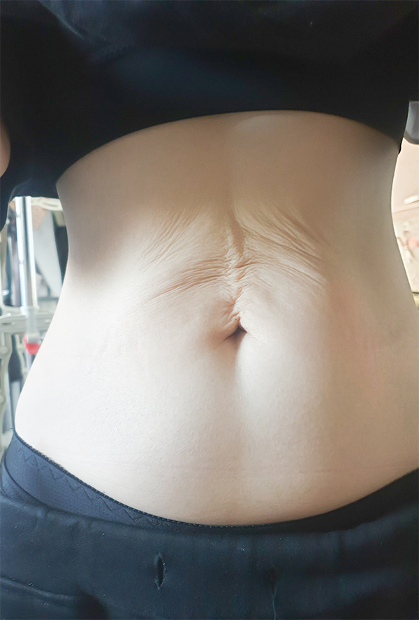 tummy-tuck-powerful-before