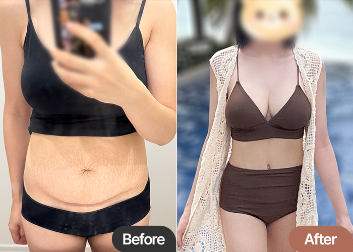 Tummy Tuck in Korea Before & After – Postpartum Loose Skin Transformation