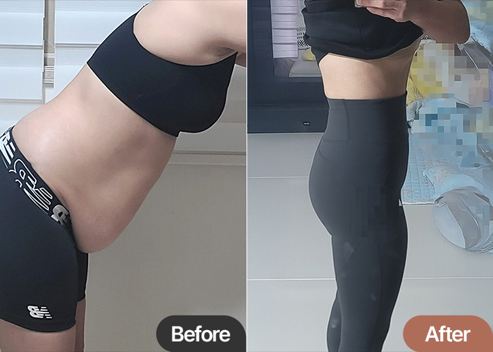 Tummy Tuck & Hip Fat Transfer in Korea Before & After – 7kg Fat Loss Transformation