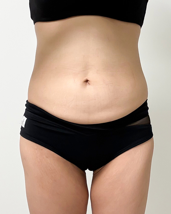 tummy-tuck-thumbnail-poltayeoni-before