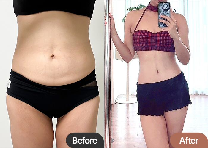 tummy-tuck-thumbnail-poltayeoni