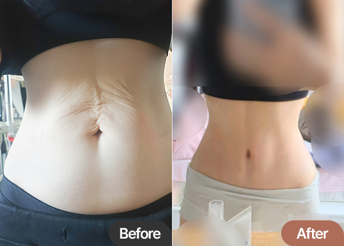 Tummy Tuck & Abdominal Liposuction in Korea Before & After – Smaller Waist & Flat Abdomen Review