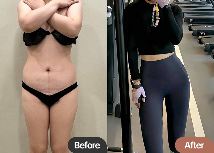 tummy-tuck-thumbnail-thdsk0810
