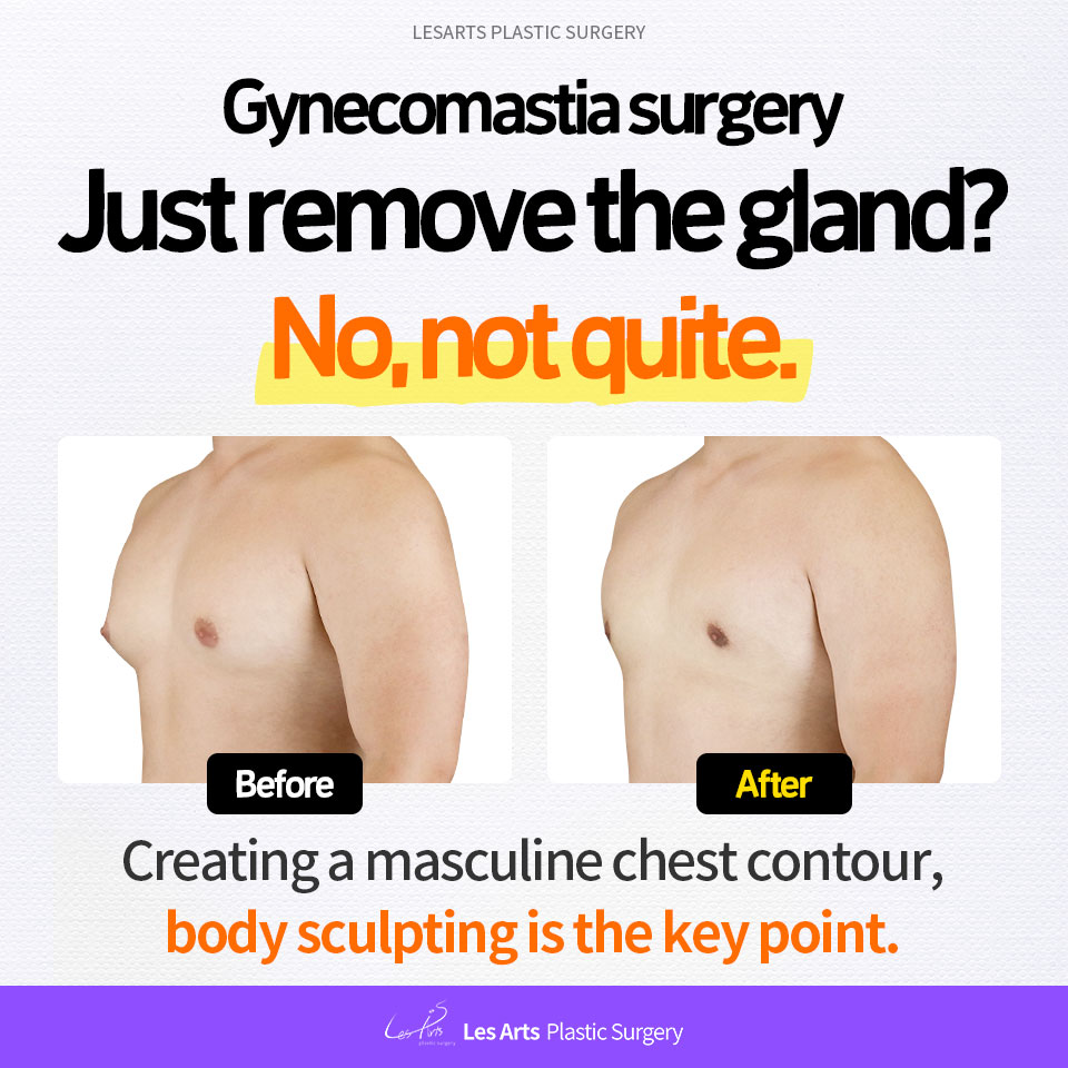 Gynecomastia Surgery:The Golden Balance of Liposuction and Gland Excision,and the Art of Sculpting