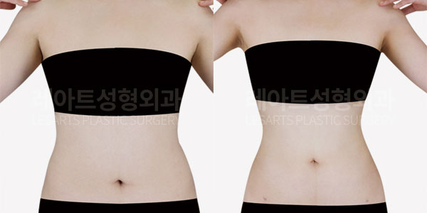 abdominal-liposuction-before-and-after