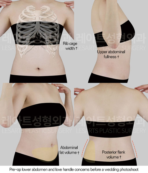 abdominal-liposuction-02-01-260610