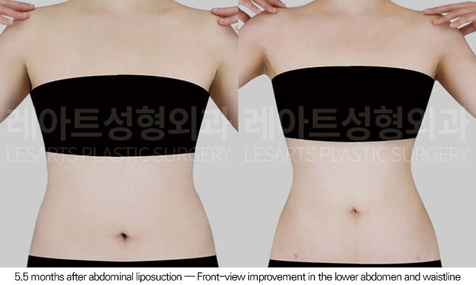 abdominal-liposuction-02-02-260610