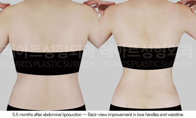 abdominal-liposuction-02-03-260610