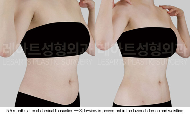 abdominal-liposuction-02-04-260610