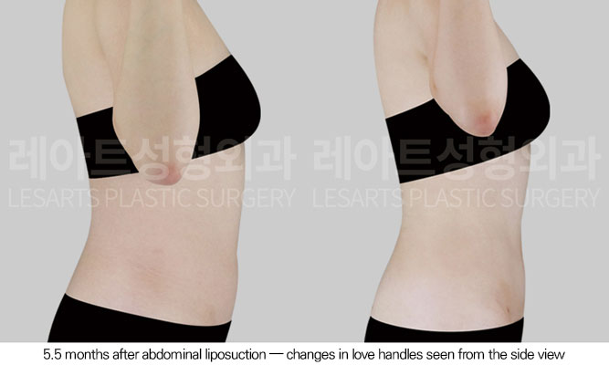 abdominal-liposuction-02-05-260610