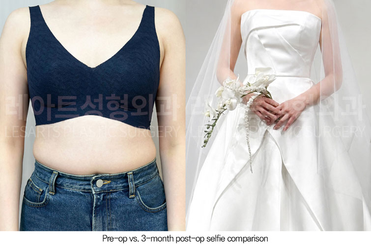 abdominal-liposuction-02-06-260610