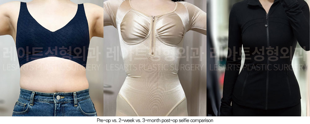 abdominal-liposuction-02-07-260610