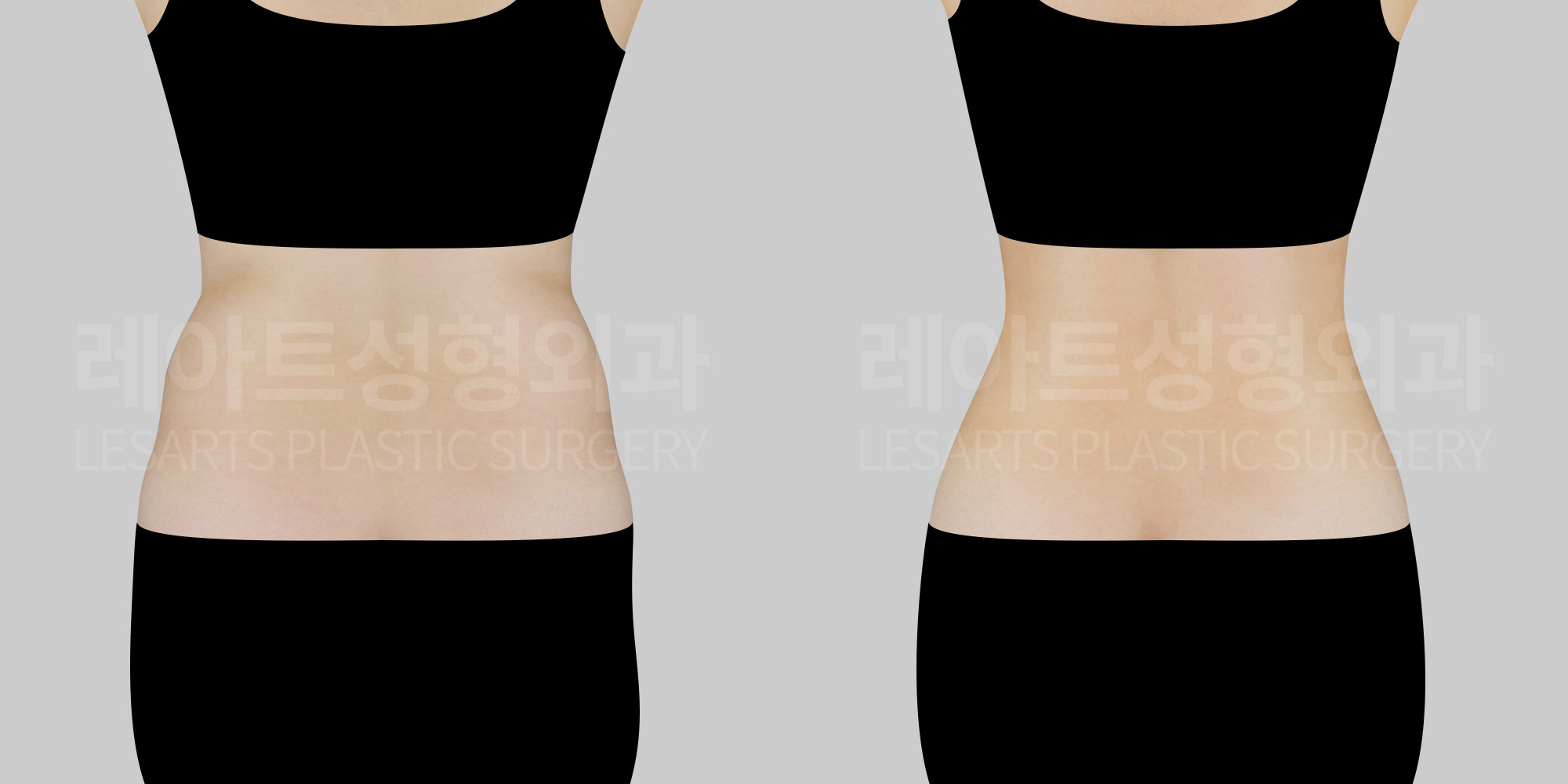abdominal-liposuction-bna-back