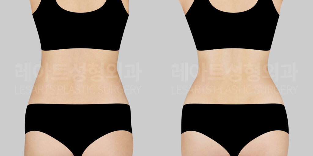 abdominal-liposuction-bna-back