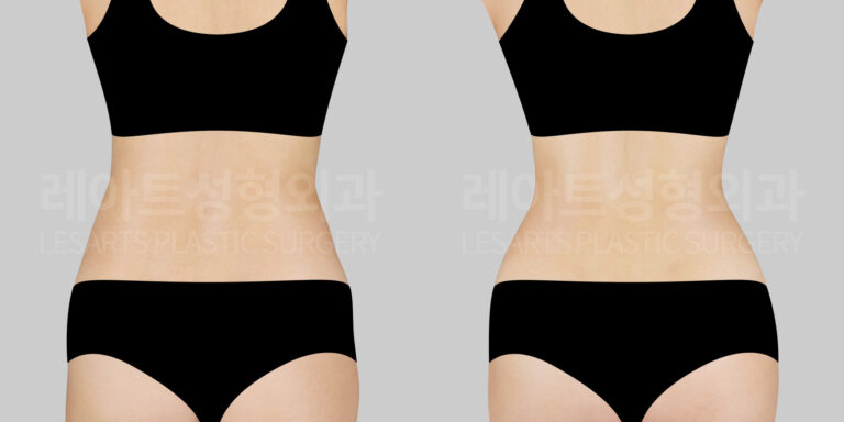 abdominal-liposuction-bna-back