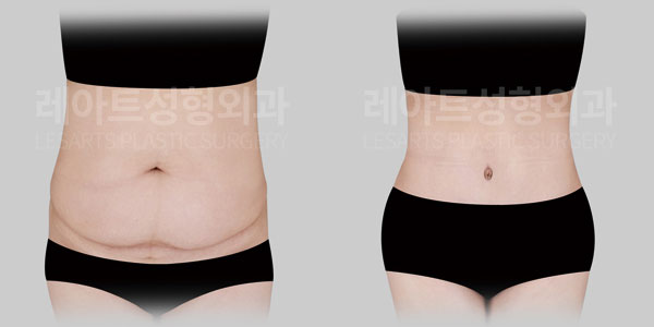 abdominoplasty before and after(lesarts)