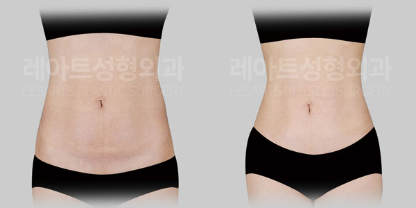 abdominoplasty before and after(lesarts)