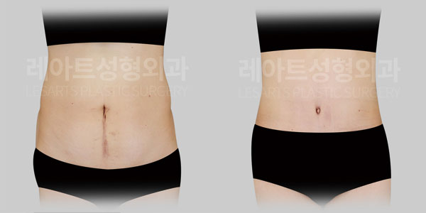 abdominoplasty before and after(lesarts)