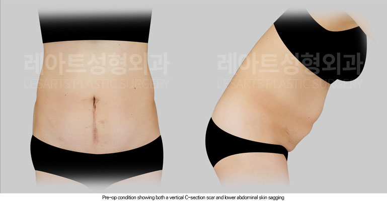 abdominoplasty-02-01-260615