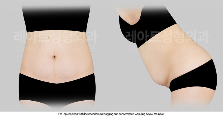 abdominoplasty-02-01-260616