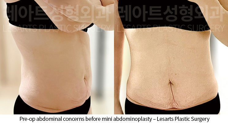 abdominoplasty-02-01-260622