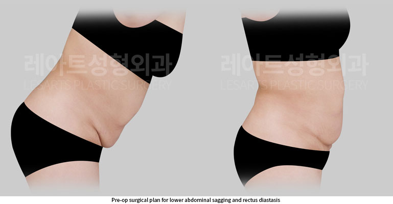 abdominoplasty-02-02-260527