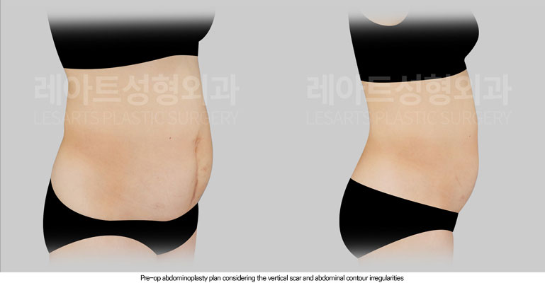 abdominoplasty-02-02-260615