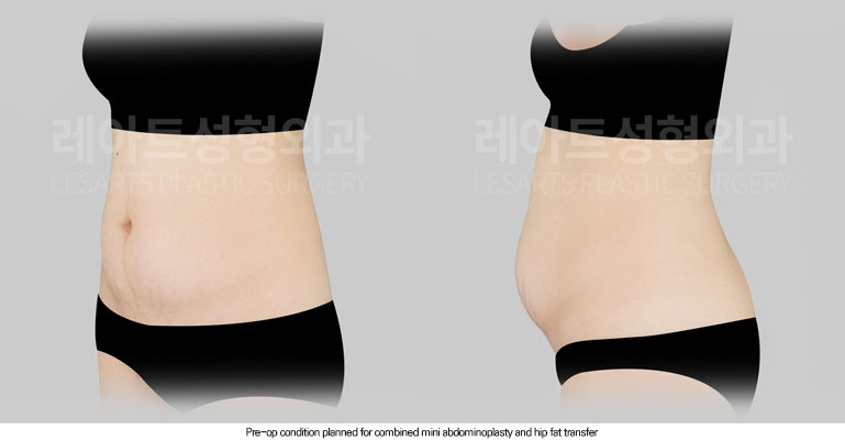 abdominoplasty-02-02-260616