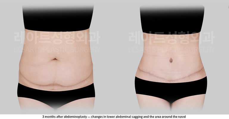 abdominoplasty-02-03-260527