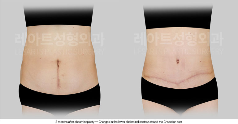 abdominoplasty-02-03-260615