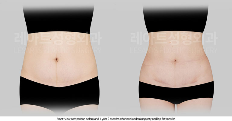 abdominoplasty-02-03-260616