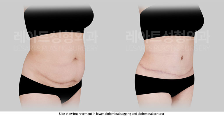 abdominoplasty-02-04-260527