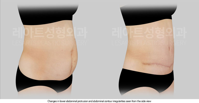abdominoplasty-02-04-260615