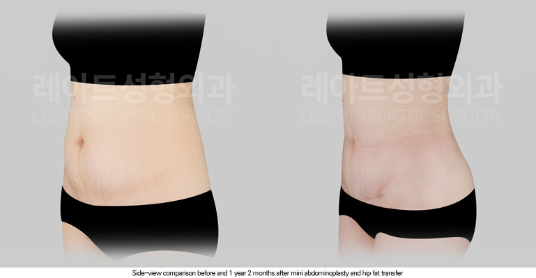 abdominoplasty-02-04-260616