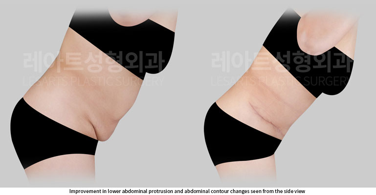 abdominoplasty-02-05-260527