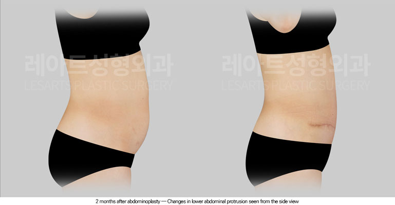 abdominoplasty-02-05-260615