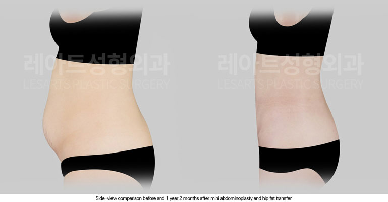 abdominoplasty-02-05-260616