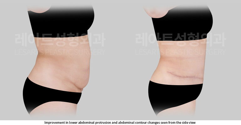 abdominoplasty-02-06-260527