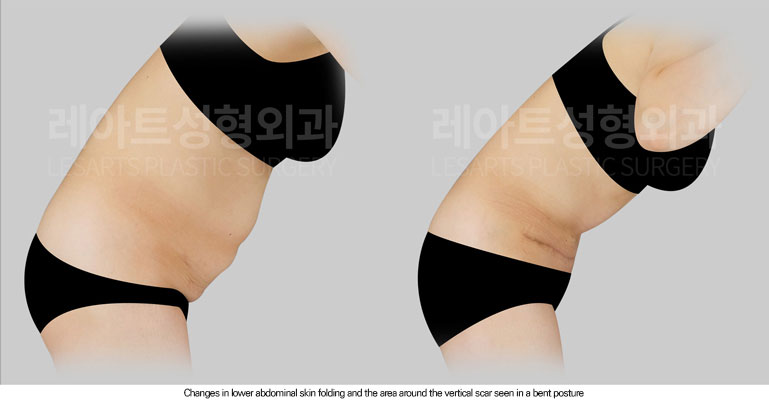 abdominoplasty-02-06-260615