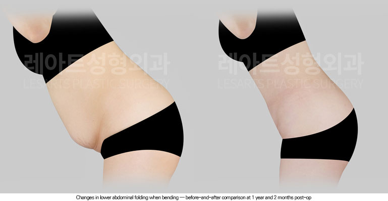 abdominoplasty-02-06-260616
