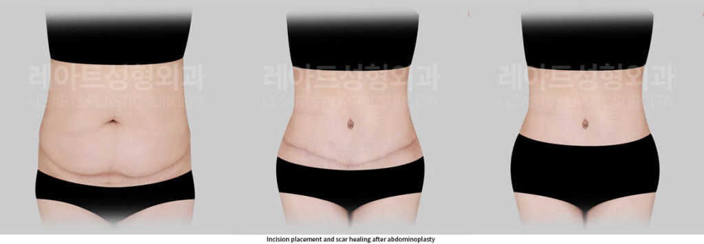 abdominoplasty-02-07-260527