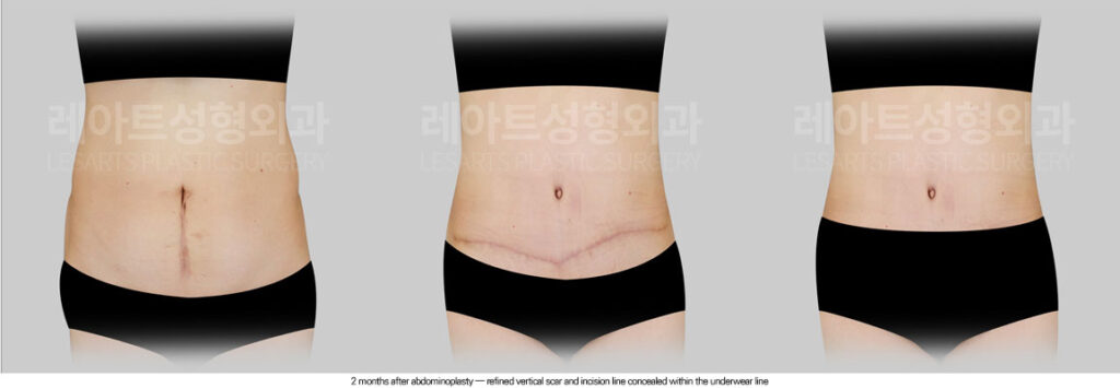 abdominoplasty-02-07-260615