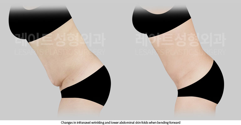 abdominoplasty-02-07-260622