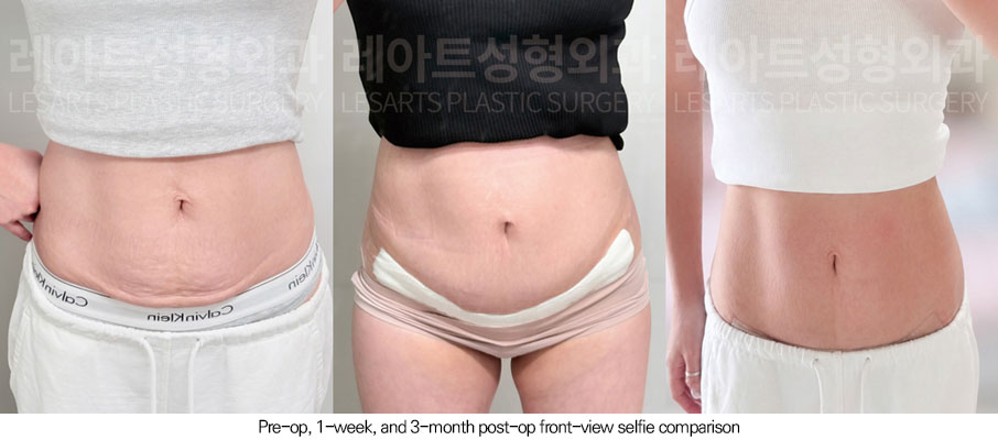 abdominoplasty-02-08-260608