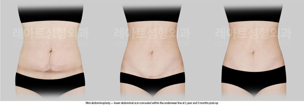 abdominoplasty-02-08-260622