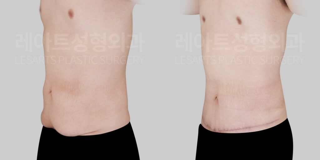 lesarts male abdominoplasty before and after